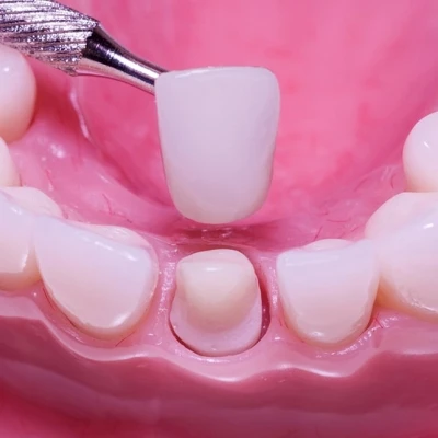 Răng sứ E-max Zirconia